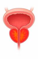 Φλεγμονή του προστάτη